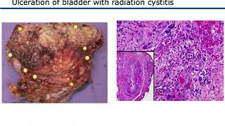 How New Guidelines will Help Interstitial Cystitis Patients [upl. by Yelrebmyk184]