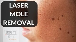 LASER MOLE REMOVAL [upl. by Hastie]