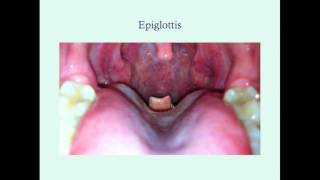 Epiglottitis  CRASH Medical Review Series [upl. by Anirtep]