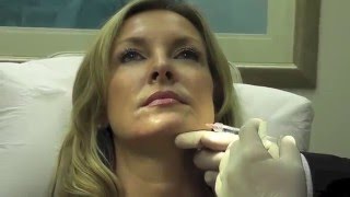 Rejuvenation of the Lower Face with Injectable Filler [upl. by Ymia575]