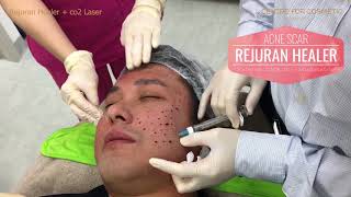 Rudy Lim  Rejuran and laser for Acne Scars  Centre for cosmetic [upl. by Saffren940]