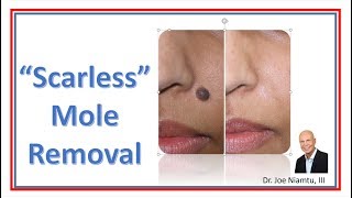 Mole Removal the Easy Way [upl. by Leunamme]