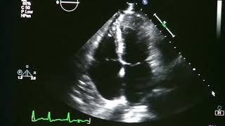 Atrial Rhythms  EKG Interpretation  LevelUpRN [upl. by Noirb488]