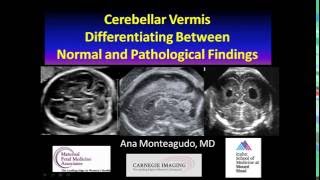 AIUM Webinar Cerebellar Vermis [upl. by Correy]