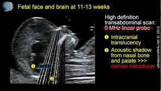 ISUOG guidelines on the sonographic examination of the fetal CNS part 1 [upl. by Ydnal92]