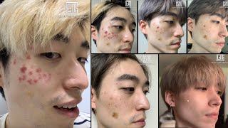 Mole Removal Before amp After  Seoul Guide Medical [upl. by Tirrell201]