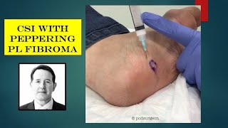 Plantar Fibromatosis  Everything You Need To Know  Dr Nabil Ebraheim [upl. by Dulla]