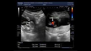 Ultrasound Video showing Anencephaly with a pregnancy of about 19 weeks [upl. by Samalla]