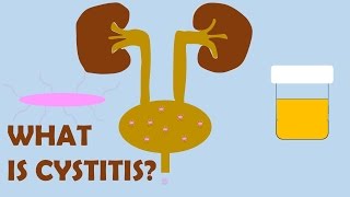 What is Cystitis [upl. by Darryn258]