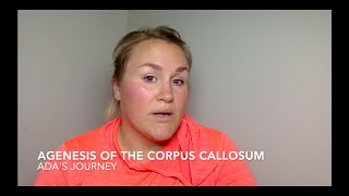 Adas Story Agenesis of the Corpus Callosum [upl. by Unam]