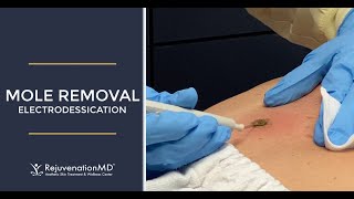 Electrodessication to Remove Seborrheic Keratosis [upl. by Audwin]