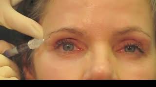 Filler Technique for Rejuvenation of the Upper Periocular Area [upl. by Ilyak297]