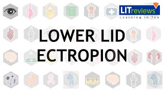 Lower Lid Ectropion [upl. by Akinyt]