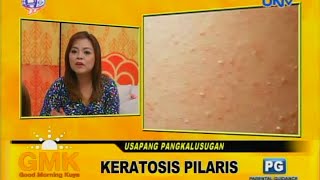 Keratosis Pilaris chicken skin [upl. by Ahseik]