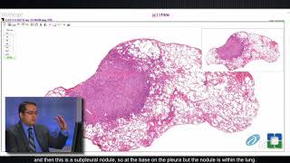 Granulomatosis with Polyangiitis pathophysiology symptoms treatment [upl. by Idrahs472]