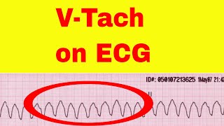 How to Zero an EVD amp Measure ICP with Neurosurgeon amp Nurse Xtina [upl. by Saville]