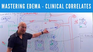 Mastering Edema  Types Causes Symptoms amp Treatment 👨‍⚕️ [upl. by Ardnal]