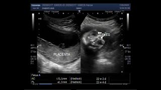 Ultrasound Video showing Anencephaly a neural tube defect [upl. by Hibben]