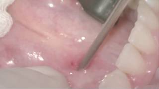 Submandibular Salivary Gland Sialendoscopy for Sialolithiasis [upl. by Ysnat]