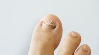 How to prevent and treat nail fungus [upl. by Peggie397]