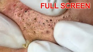 Blackheads removal  Best Pimple Popping Videos [upl. by Aspasia]