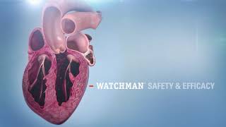 WATCHMAN™ Implant Animation [upl. by Hijoung693]