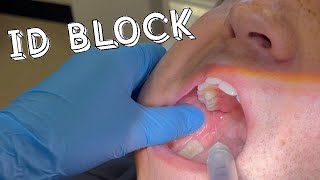 HOW TO SUCCEED AT AN INFERIOR DENTAL NERVE BLOCK INJECTION  DENTISTRY  Profound amp Painless [upl. by Auj273]