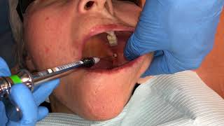 Inferior Alveolar and Lingual Nerve Blocks [upl. by Ym]