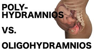 Polyhydramnios vs Oligohydramnios [upl. by Sigfrid]