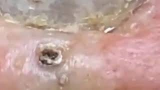 Blackheads • Nose Blackheads • Blackheads 2021 New • Blackheads On Nose • Blackheads Nose [upl. by Gerty]