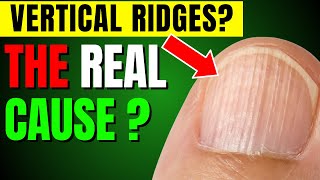 How to reduce Vertical Ridges in Nails [upl. by Dustan]