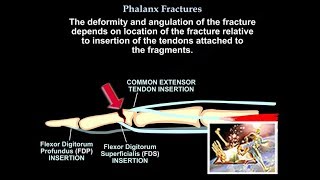 Phalanx Fractures  Everything You Need To Know  Dr Nabil Ebraheim [upl. by Manon]