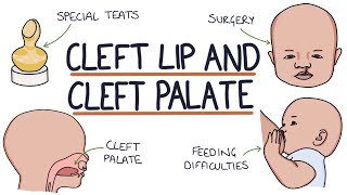 Cleft Lip and Cleft Palate For Students [upl. by Kiefer]