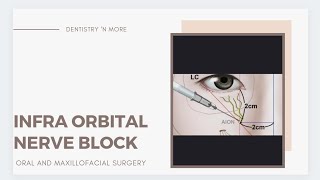 INFRA ORBITAL NERVE BLOCK [upl. by Amehr]