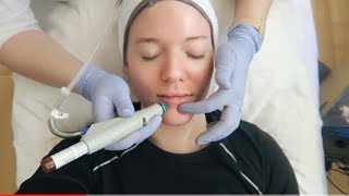 HYDRAFACIAL TREATMENT Before amp After [upl. by Pirri]