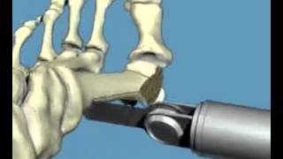 The Procedure  Osteotomy [upl. by Noryak630]