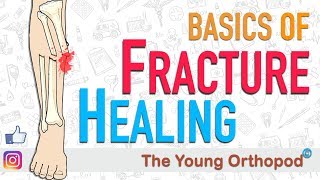 Fracture Healing  ANIMATION  BASICS  The Young Orthopod [upl. by Attenwad]