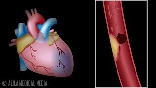 Leg Vein Valve  Normal  3D Medical Animation  ABP © [upl. by Smiley]