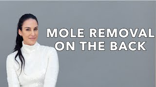 Mole Removal on The Back  Nazarian Plastic Surgery [upl. by Litton795]