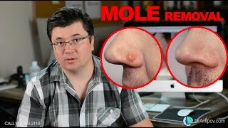 MOLE REMOVAL SCARLESS  Patient shares his experience [upl. by Ainival]