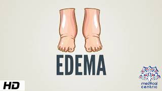 Edema Causes Signs and Symptoms Diagnosis and Treatment [upl. by Burgwell]