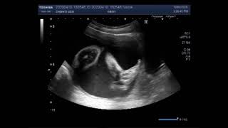 Ultrasound Video showing the case of Anencephaly [upl. by Christoffer]