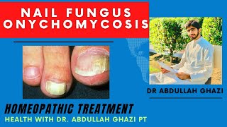 Onychomycosis  Nail Fungus Homeopathic Treatment  Dr Abdullah Ghazi [upl. by Ivo]