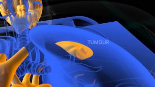 PET Scan animation [upl. by Neahs904]