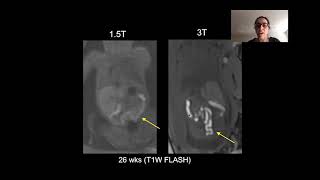 Key screening views of the fetal heart  Part 3  4chamber view [upl. by Rebeh429]