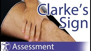 Clarkes Sign  Patellar Grind Test  Patellofemoral Pain  Chondromalacia Patellae [upl. by Lexy918]