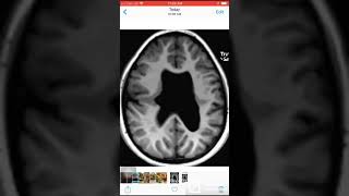 Schizophrenia  Types Symptoms Etiology Phases Differential Diagnoses Treatment  MisMedicine [upl. by Jacquenette]