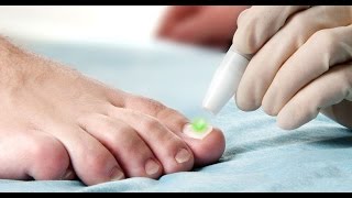 Toenail Fungus Onychomycosis treatment using the FOX Laser [upl. by Primalia]