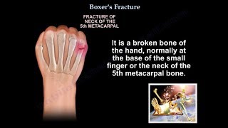 Boxers Fracture  Everything You Need To Know  Dr Nabil Ebraheim [upl. by Baggott]