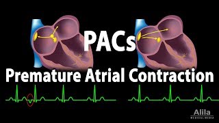 Ventricular Tachycardia ECG  EMTprepcom [upl. by Beller]